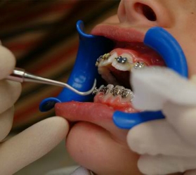 Orthodontic Adjustment