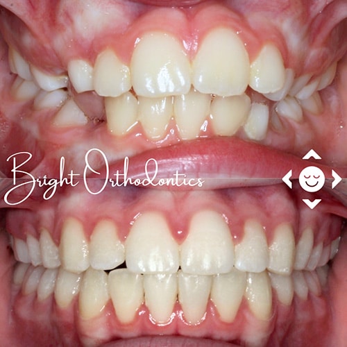 Close-up of crooked teeth before orthodontic treatment | Bright Orthodontics in Oshkosh, WI