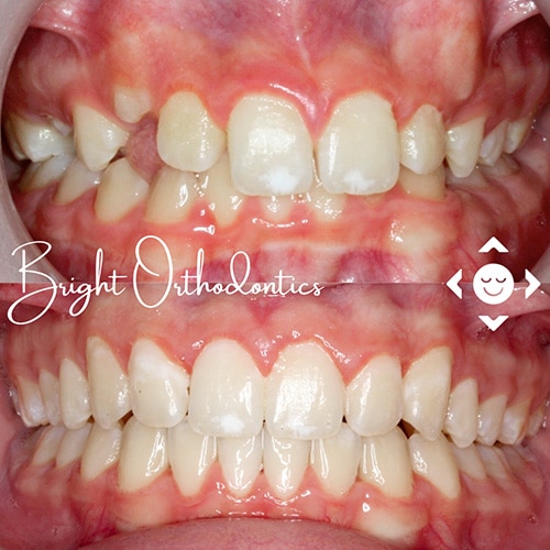 Close-up of teeth showing improved alignment | Bright Orthodontics in Oshkosh, WI