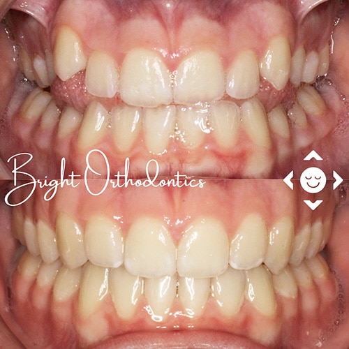 Close-up of straight smile after orthodontic care | Bright Orthodontics in Oshkosh, WI