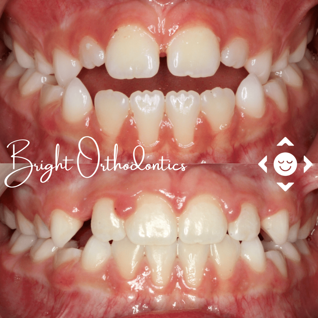 Close-up of front teeth with slight gap before care | Bright Orthodontics in Oshkosh, WI