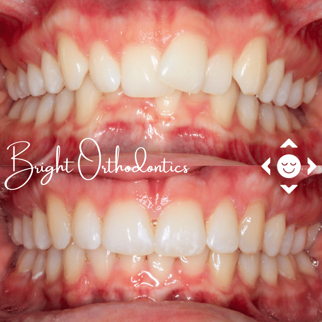 Close-up of front teeth with clear aligner trays | Bright Orthodontics in Oshkosh, WI