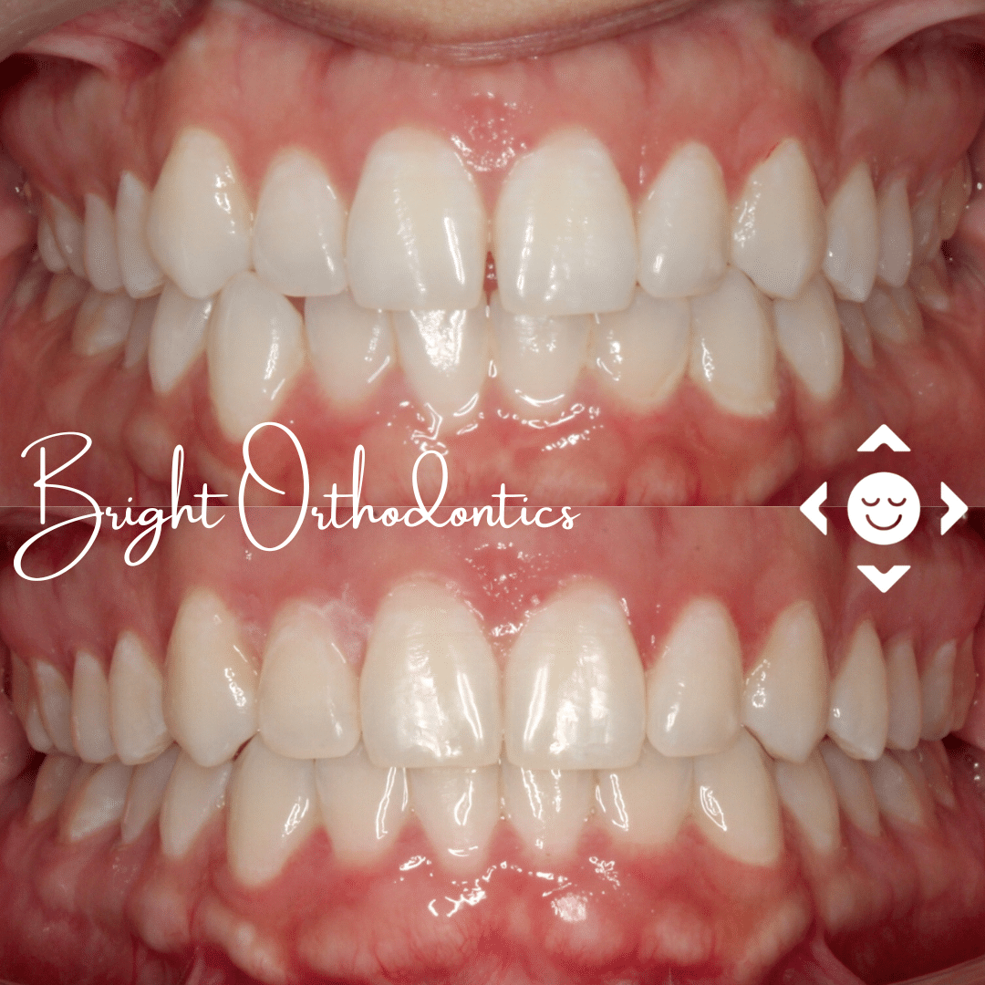 Close-up of straight smile with clear aligners | Bright Orthodontics in Oshkosh, WI