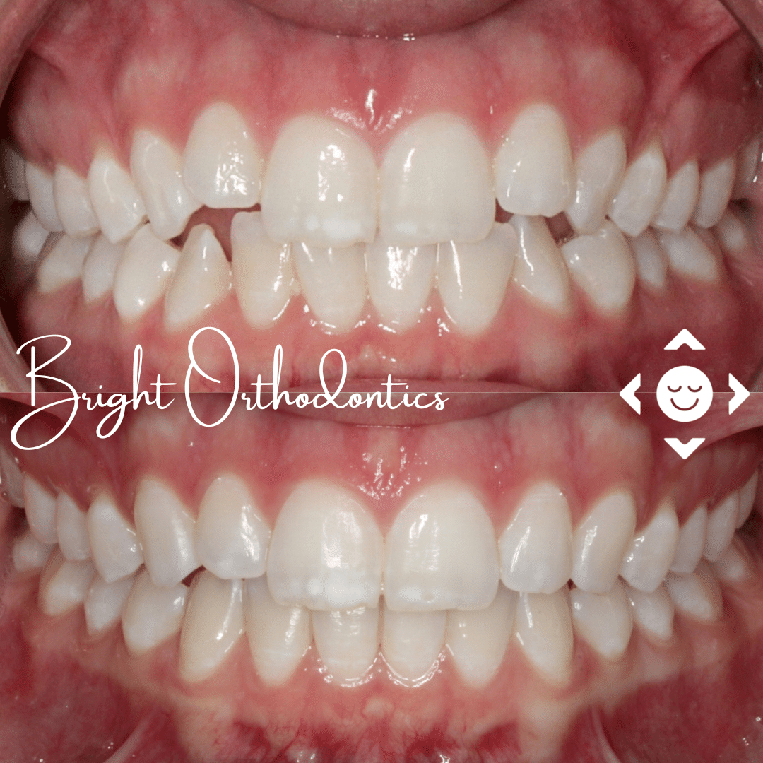 Close-up of teeth wearing clear aligner trays | Bright Orthodontics in Oshkosh, WI