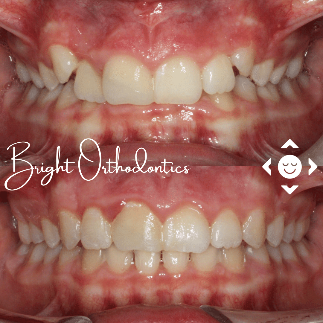Close-up of teeth with clear aligner trays | Bright Orthodontics in Oshkosh, WI