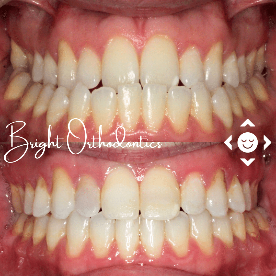 Close-up of teeth showing jaw alignment correction | Bright Orthodontics in Oshkosh, WI
