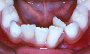 Common Problems Crowding Bite