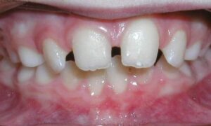 Common Problem Spacing Teeth